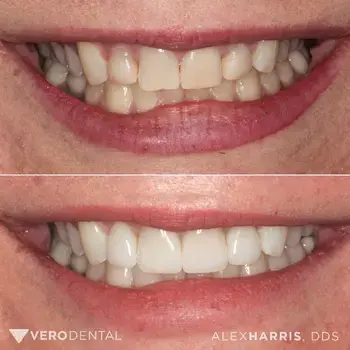 Teeth Whitening result at Vero Dental in Lehi, UT