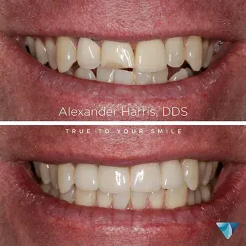 Dental Crowns result at Vero Dental in Lehi, UT