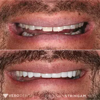 Vero Dental veneers result — Lehi, UT