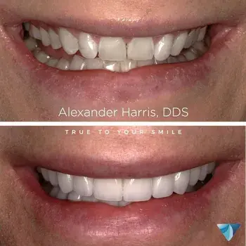 Dental Implants result at Vero Dental in Lehi, UT