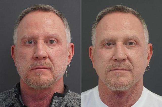 Neck Lift result at Thompson Facial Plastics in Denver, CO