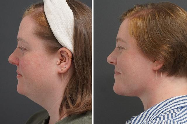 Neck Lift result at Thompson Facial Plastics in Denver, CO