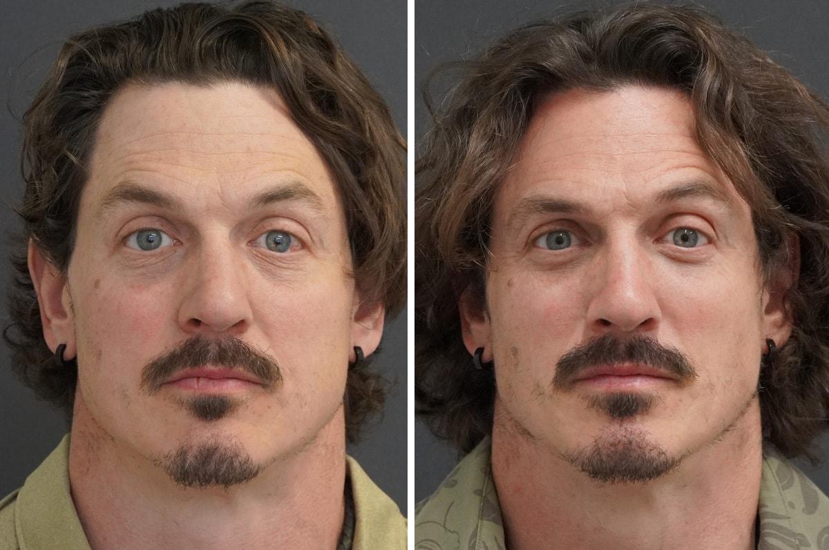 Thompson Facial Plastics rhinoplasty result — Denver, CO