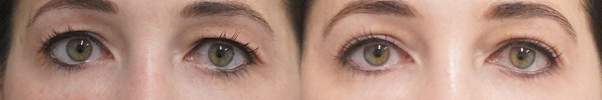 Thompson Facial Plastics eyelid lift result — Denver, CO