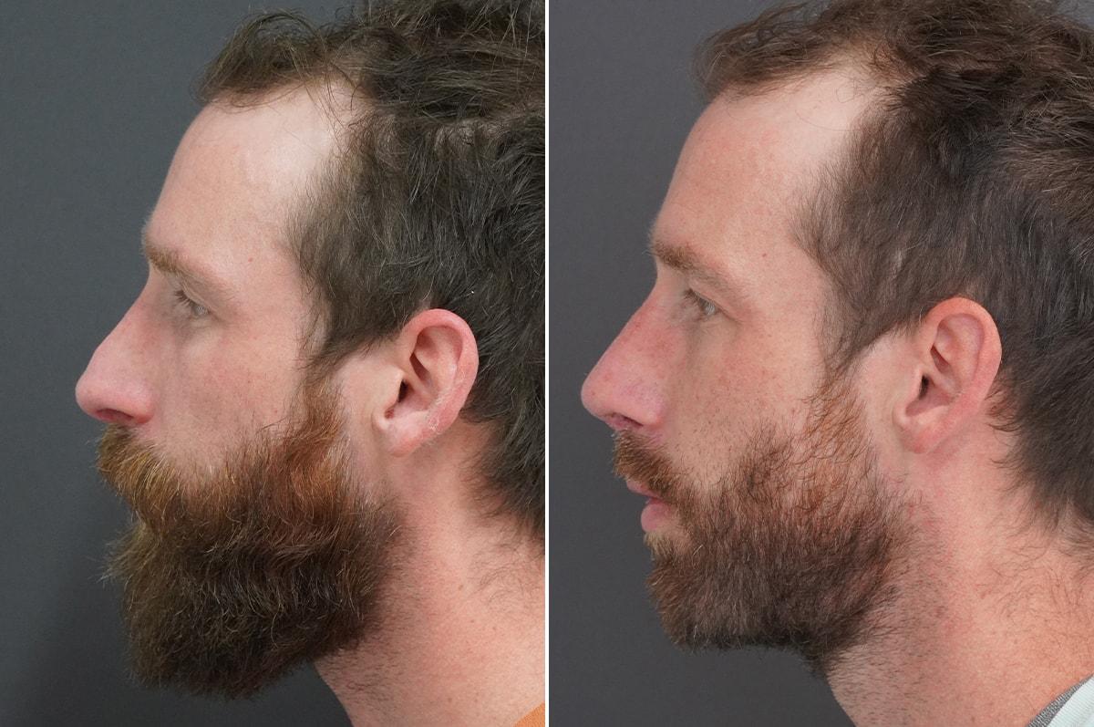 Thompson Facial Plastics rhinoplasty result — Denver, CO