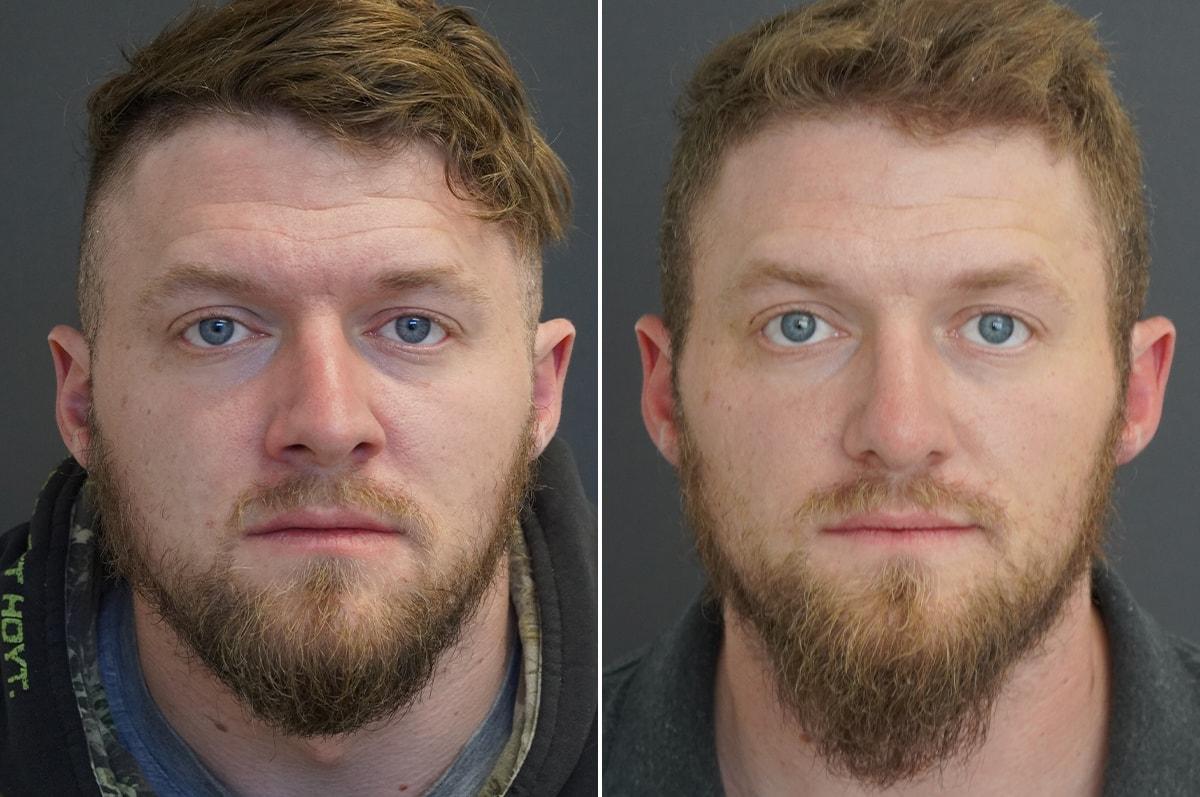 Thompson Facial Plastics rhinoplasty result — Denver, CO