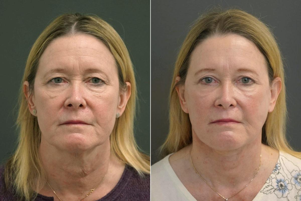 Thompson Facial Plastics facelift result — Denver, CO