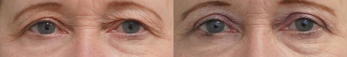 Thompson Facial Plastics eyelid lift result — Denver, CO