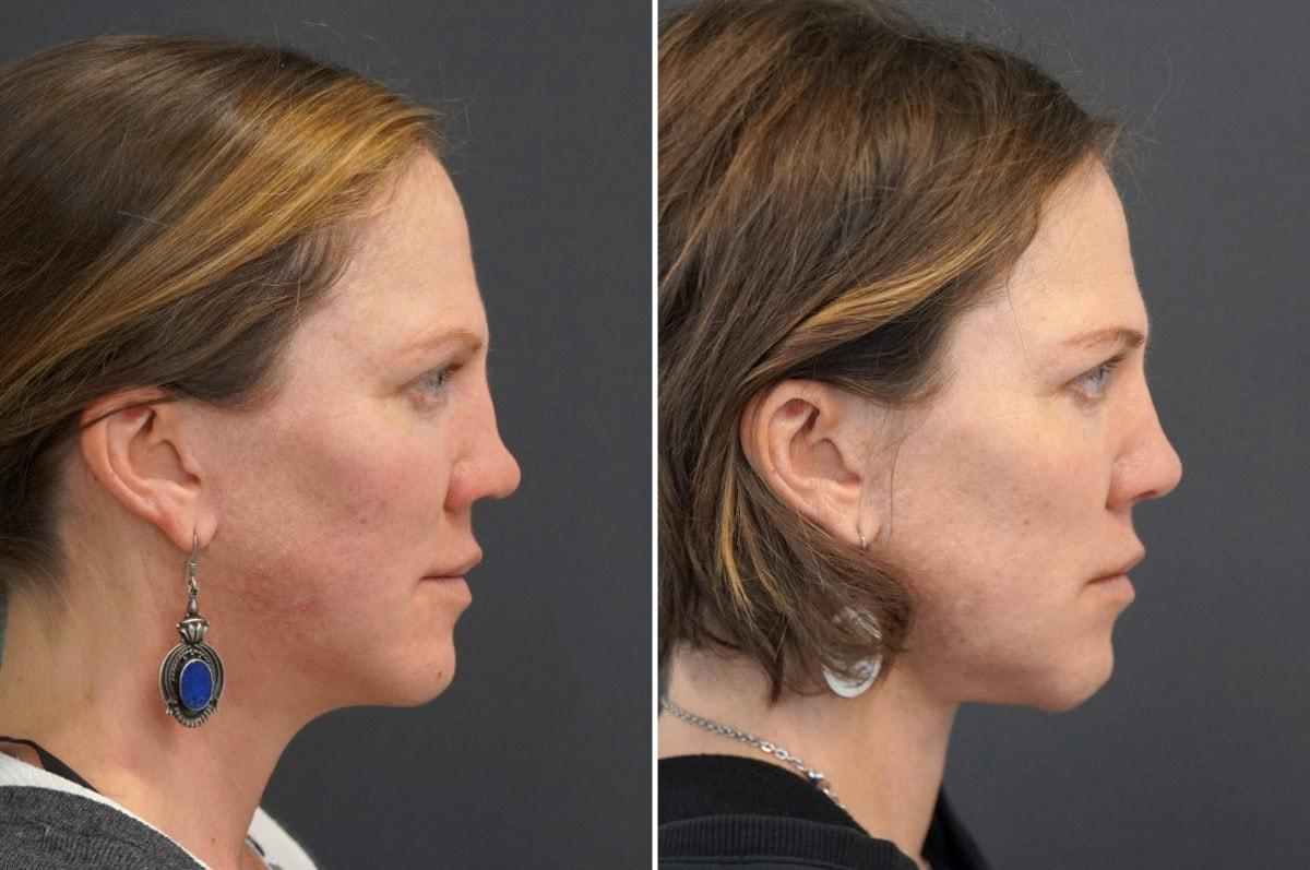 Thompson Facial Plastics rhinoplasty result — Denver, CO