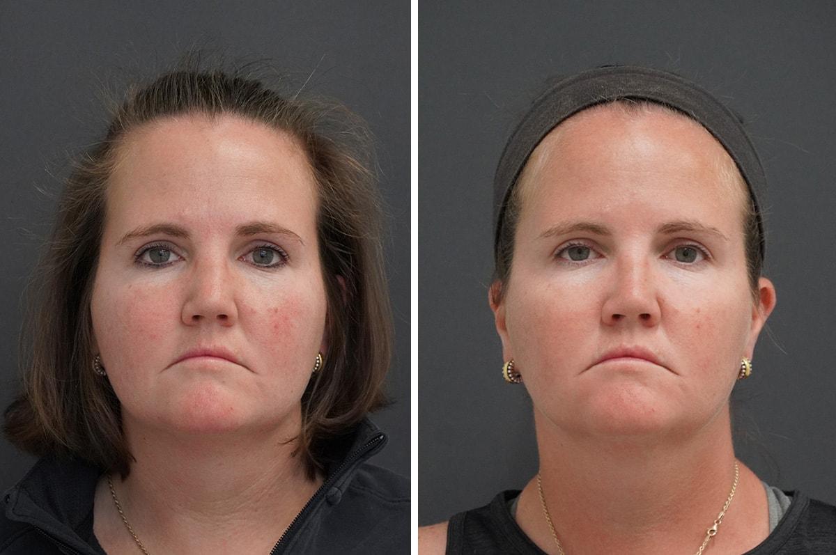 Thompson Facial Plastics rhinoplasty result — Denver, CO
