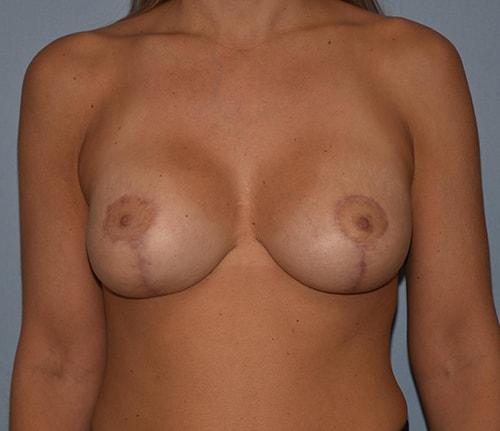 John Layliev, MD, FACS breast lift after — Melville, NY