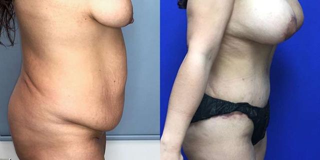 Mini Tummy Tuck result at Dr. Jeneby Plastic Surgery in San Antonio, TX