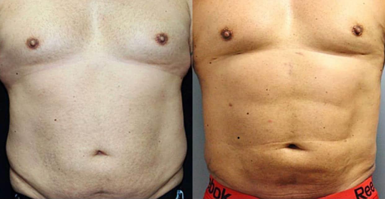 Dr. Jeneby Plastic Surgery liposuction result — San Antonio, TX