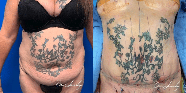 Dr. Jeneby Plastic Surgery result — San Antonio, TX