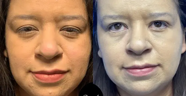 Blepharoplasty result at Dr. Jeneby Plastic Surgery in San Antonio, TX