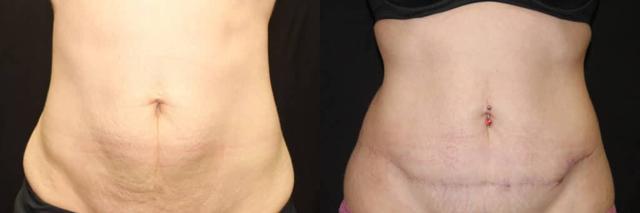 Mini Tummy Tuck result at Dr. Jeneby Plastic Surgery in San Antonio, TX