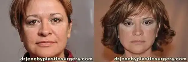 Deep Plane Facelift result at Dr. Jeneby Plastic Surgery in San Antonio, TX