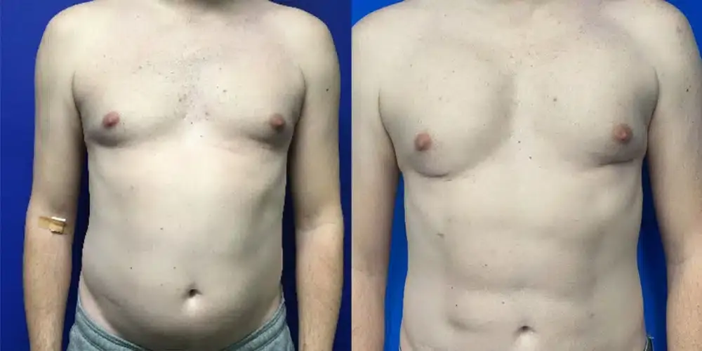 Dr. Jeneby Plastic Surgery liposuction result — San Antonio, TX