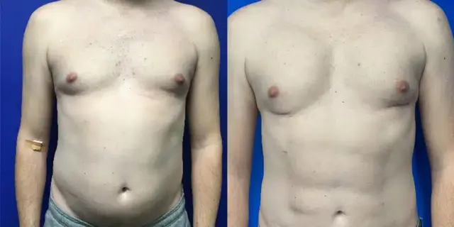 Liposuction result at Dr. Jeneby Plastic Surgery in San Antonio, TX