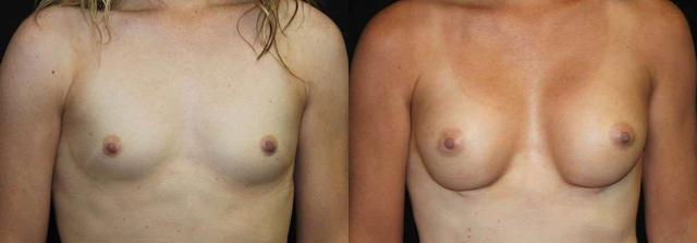 Breast Augmentation result at Dr. Jeneby Plastic Surgery in San Antonio, TX