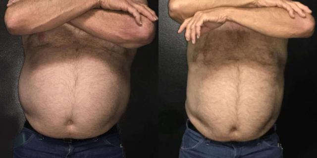 Arm Lift result at Dr. Jeneby Plastic Surgery in San Antonio, TX
