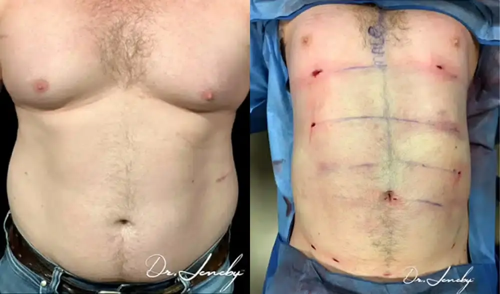 Dr. Jeneby Plastic Surgery liposuction result — San Antonio, TX
