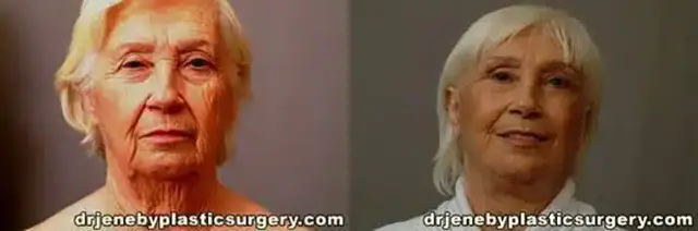 Deep Plane Facelift result at Dr. Jeneby Plastic Surgery in San Antonio, TX