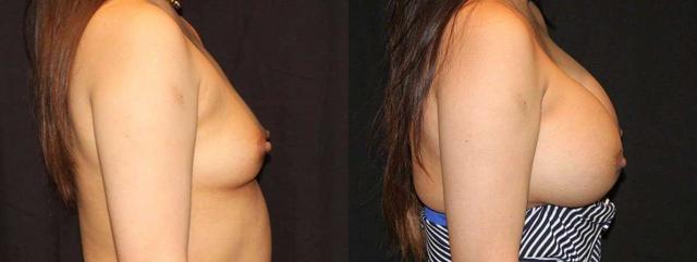 Breast Augmentation result at Dr. Jeneby Plastic Surgery in San Antonio, TX