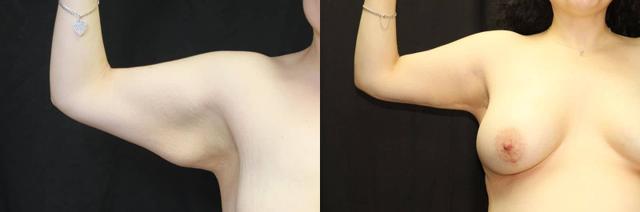 Arm Lift result at Dr. Jeneby Plastic Surgery in San Antonio, TX