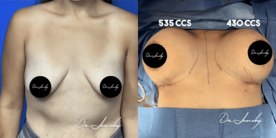 Dr. Jeneby Plastic Surgery result — San Antonio, TX