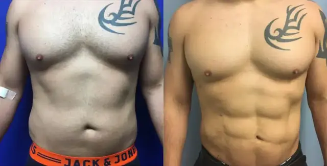 Liposuction result at Dr. Jeneby Plastic Surgery in San Antonio, TX