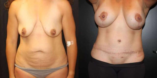 Mommy Makeover result at Dr. Jeneby Plastic Surgery in San Antonio, TX
