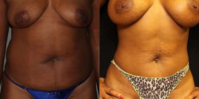 Mommy Makeover result at Dr. Jeneby Plastic Surgery in San Antonio, TX