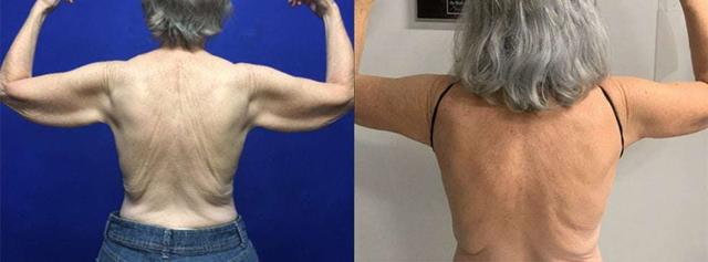 Arm Lift result at Dr. Jeneby Plastic Surgery in San Antonio, TX