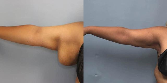 Arm Lift result at Dr. Jeneby Plastic Surgery in San Antonio, TX