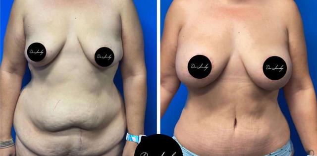 Mommy Makeover result at Dr. Jeneby Plastic Surgery in San Antonio, TX
