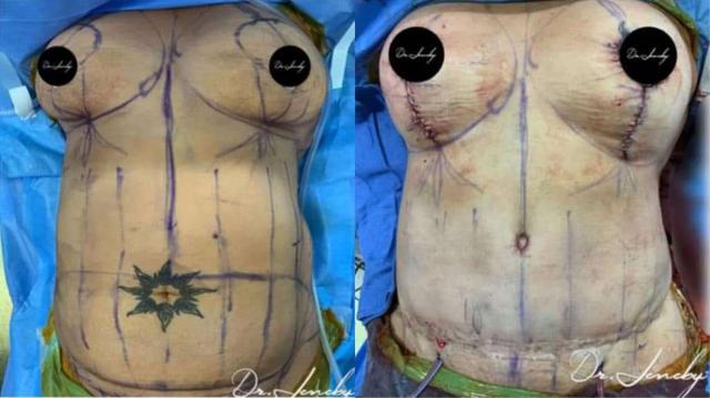 Mommy Makeover result at Dr. Jeneby Plastic Surgery in San Antonio, TX