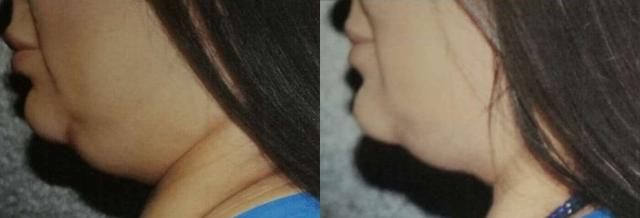 Arm Lift result at Dr. Jeneby Plastic Surgery in San Antonio, TX