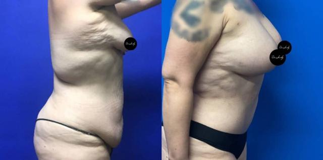 Mommy Makeover result at Dr. Jeneby Plastic Surgery in San Antonio, TX