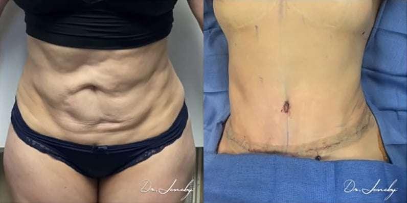 Dr. Jeneby Plastic Surgery result — San Antonio, TX