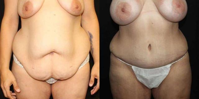 Mini Tummy Tuck result at Dr. Jeneby Plastic Surgery in San Antonio, TX