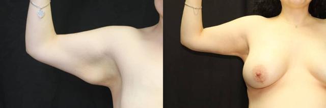Arm Lift result at Dr. Jeneby Plastic Surgery in San Antonio, TX