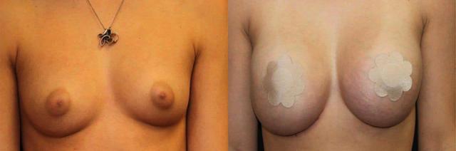 Breast Lift result at Dr. Jeneby Plastic Surgery in San Antonio, TX
