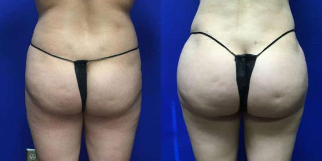Brazilian Butt Lift result at Dr. Jeneby Plastic Surgery in San Antonio, TX