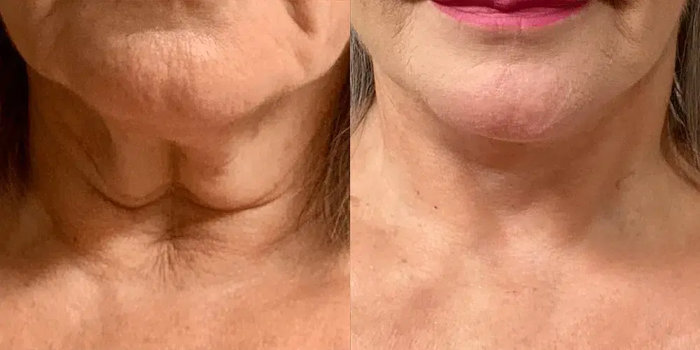 Dr. Jeneby Plastic Surgery neck lift result — San Antonio, TX
