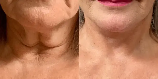 Neck Lift result at Dr. Jeneby Plastic Surgery in San Antonio, TX