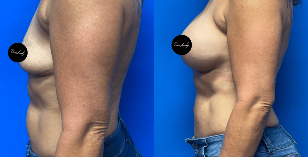 Dr. Jeneby Plastic Surgery result — San Antonio, TX
