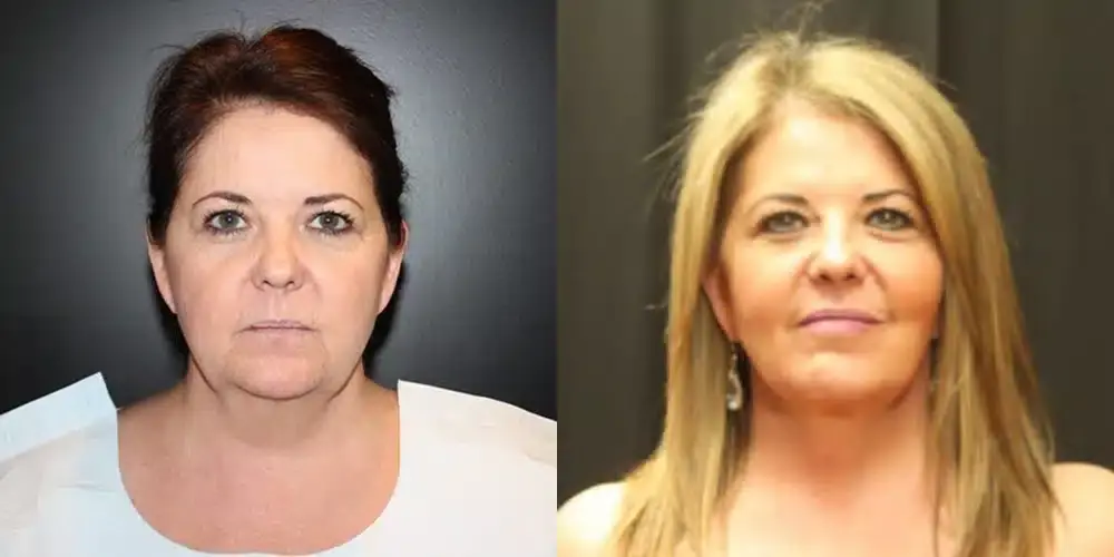 Dr. Jeneby Plastic Surgery neck lift result — San Antonio, TX