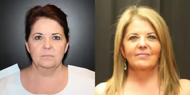 Deep Plane Facelift result at Dr. Jeneby Plastic Surgery in San Antonio, TX