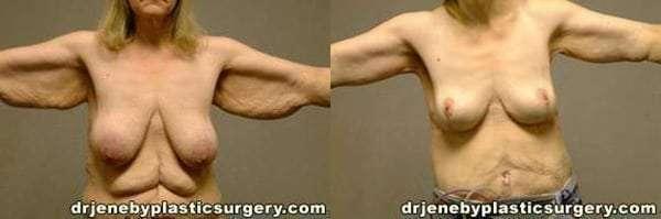 Mommy Makeover result at Dr. Jeneby Plastic Surgery in San Antonio, TX